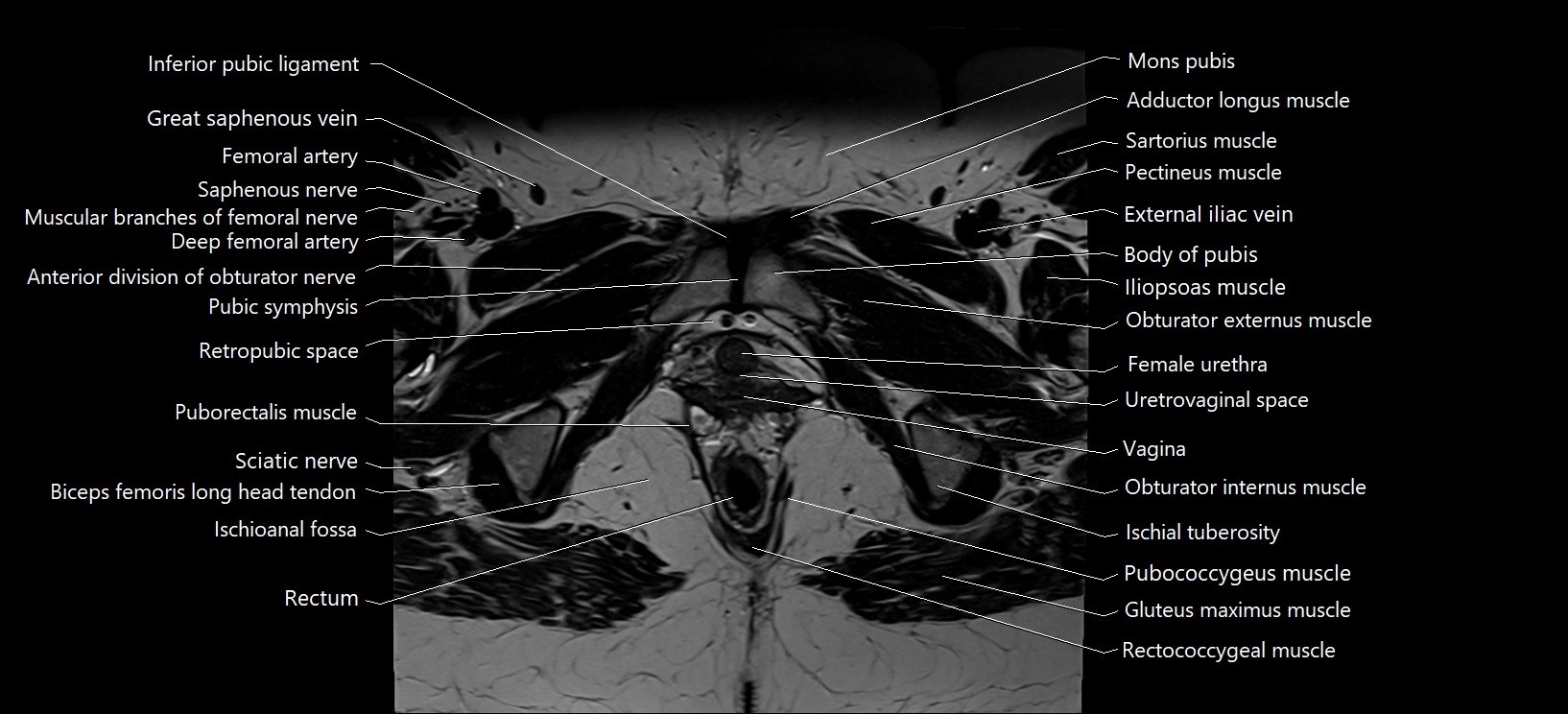 Axial cross sectional anatomy of female pelvis (MRI 3T) image 36.webp